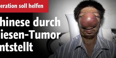 Chinese durch Riesen-Tumor entstellt