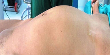 17-J&auml;hrige trug toten Zwilling im Bauch