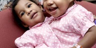 Siamesische Zwillinge erfolgreich getrennt