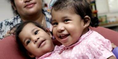 Siamesische Zwillinge erfolgreich getrennt