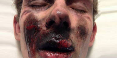 E-Zigarette explodiert: Zähne verloren