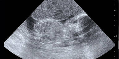 Baby 3 Monate nach Tod der Mutter geboren