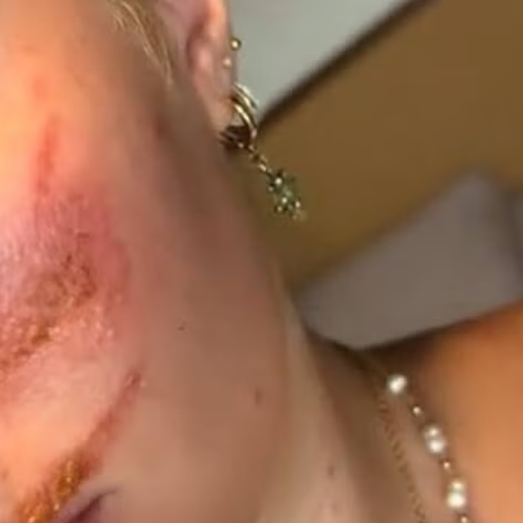 Junge Urlauberin wacht nach Party auf – und ist übersät mit Wunden