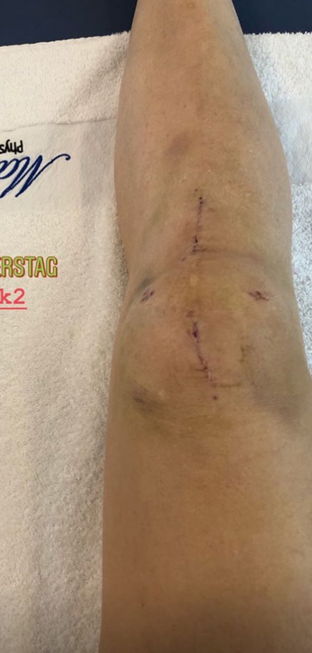 Anna Veith zeigt ihr Horror-Knie