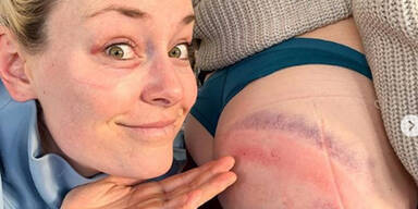 Popo-Posting: Vonn & Co zeigen blaue Flecken