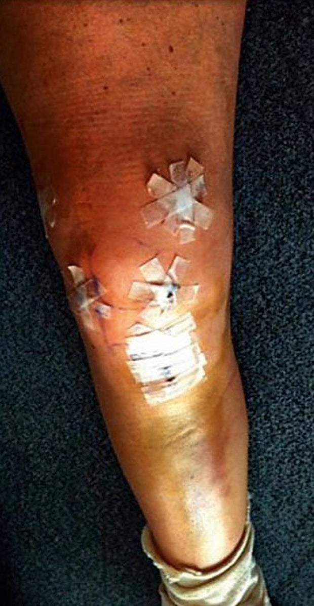 Lindsey Vonns Spitals-Akte