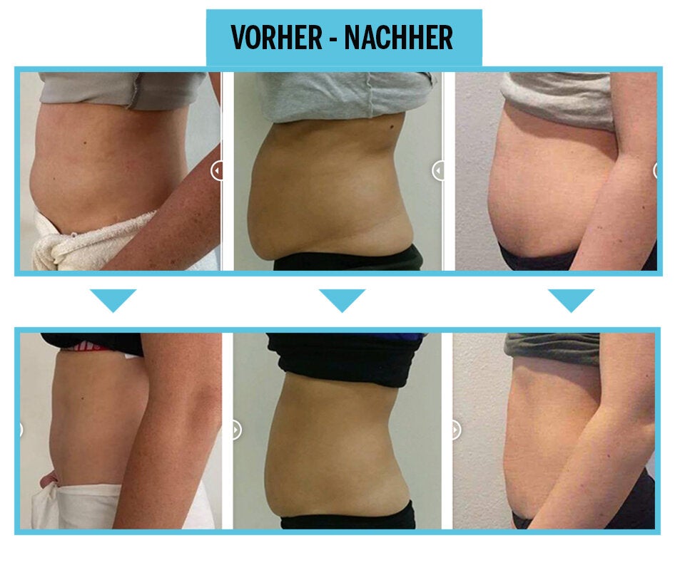 Fett reduzieren ohne Operation oder Fasten