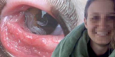 Frau hatte 14 lebende W&uuml;rmer im Auge