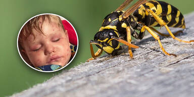 150 Wespenstiche! Kleinkind (2) kämpft um sein Leben