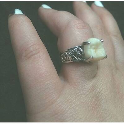 Weißheitszahn als Verlobungsring 