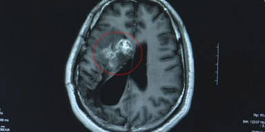 Chinese hatte 15 Jahre lang Bandwurm im Gehirn