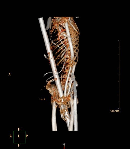 Mann von Zaunstange durchbohrt