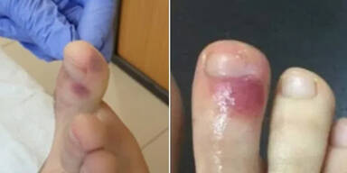 Blaue Flecken k&ouml;nnten auf Corona-Infektion hindeuten