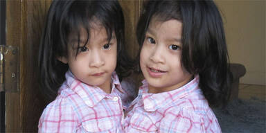 Ärzte trennen siamesische Zwillinge