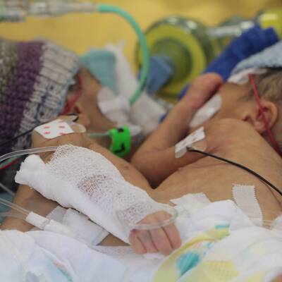 Siamesische Zwillinge 8 Tage nach Geburt getrennt