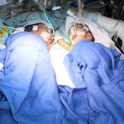 Siamesische Zwillinge 8 Tage nach Geburt getrennt