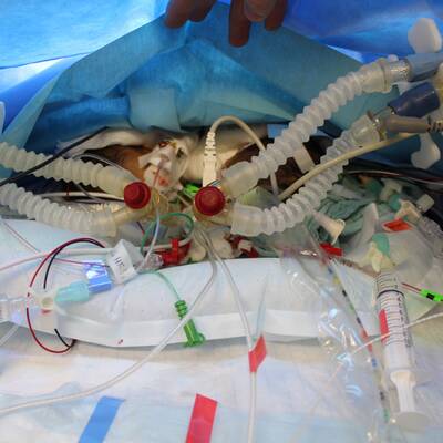 Siamesische Zwillinge 8 Tage nach Geburt getrennt