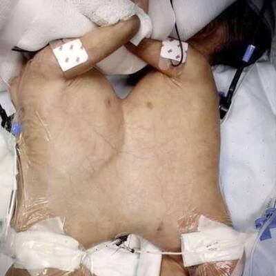 Siamesische Zwillinge 8 Tage nach Geburt getrennt