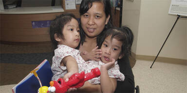 Ärzte trennen siamesische Zwillinge