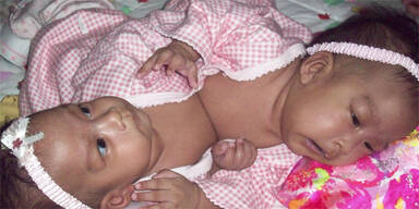 Ärzte trennen siamesische Zwillinge